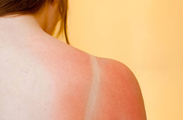 家庭用脱毛器の使用中は日焼けに注意